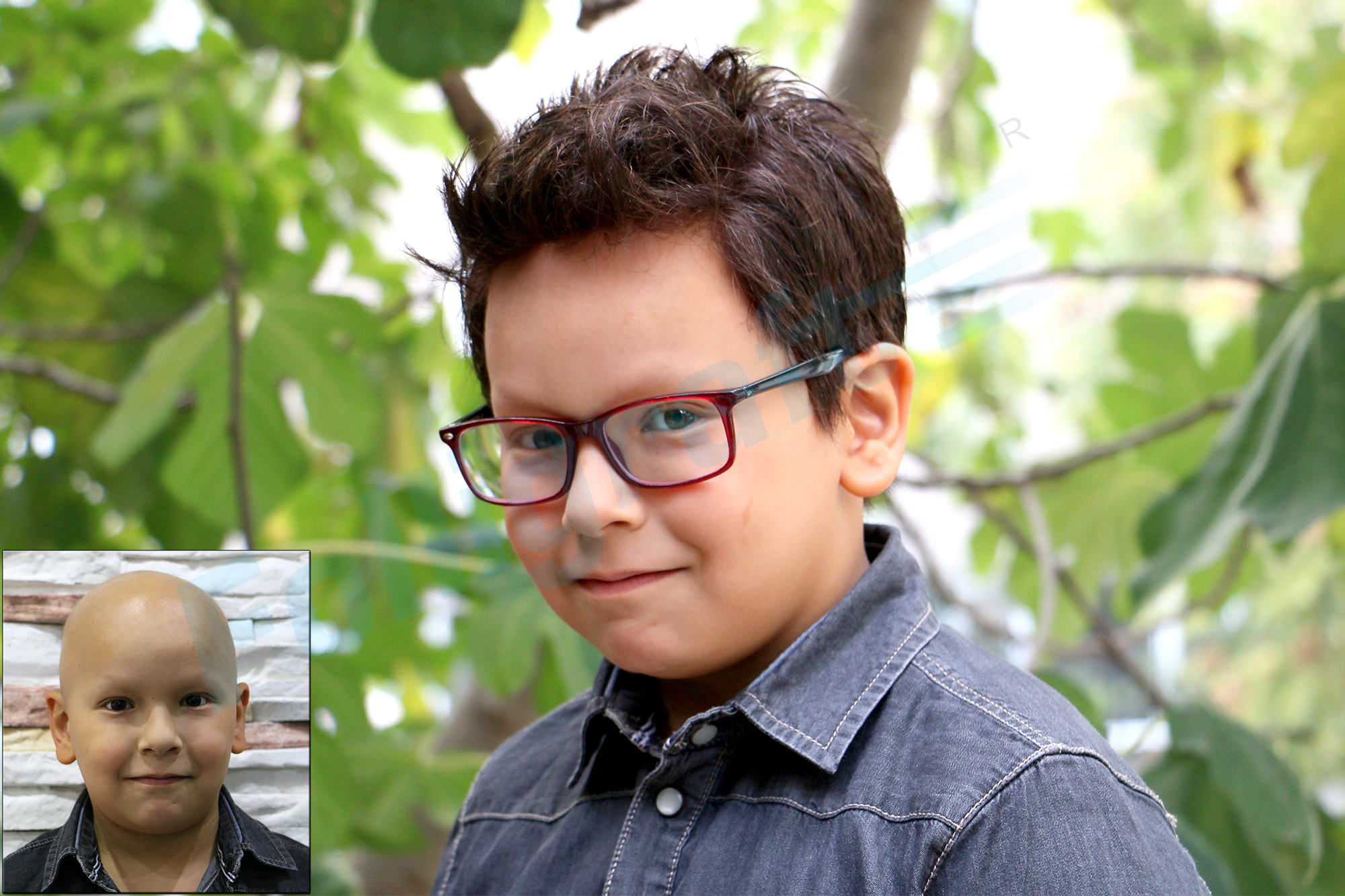 folligraft, nova hair, alopesi, folligraft nasıl uygulanır, protez saç nova